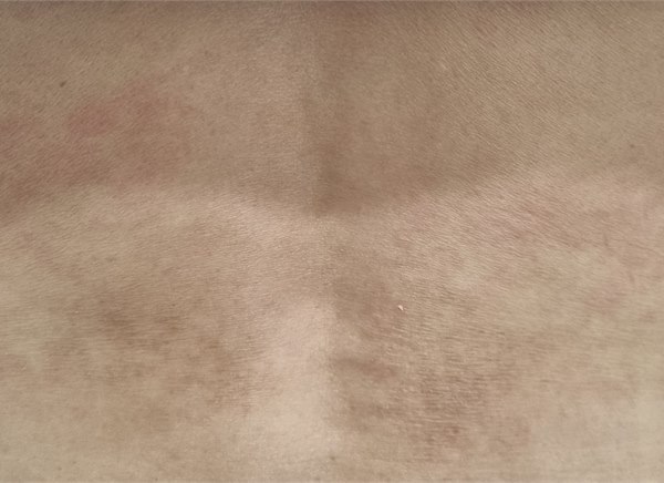 원인을 알 수 없는 전신 가려움증